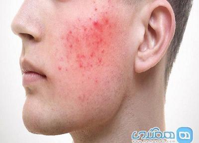 بیماری پوستی که در مردان شدیدتر است بیماری پوستی که در مردان شدیدتر است